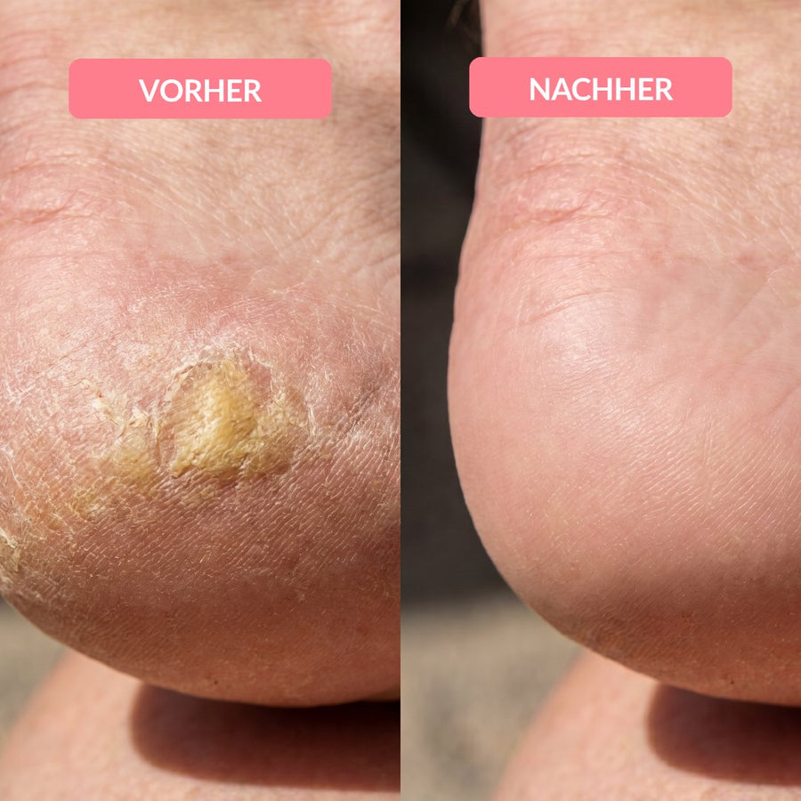 Ferse mit dicker Hornhaut vorher, glatte Ferse nachher