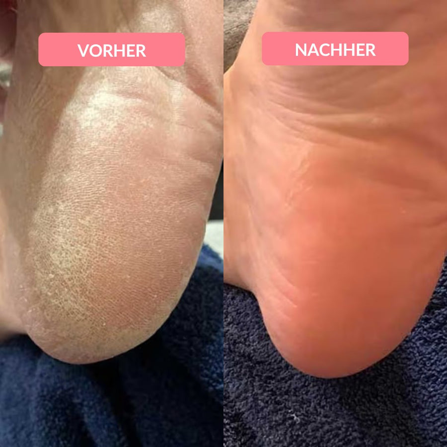Raue Ferse vorher, gepflegte Ferse nachher