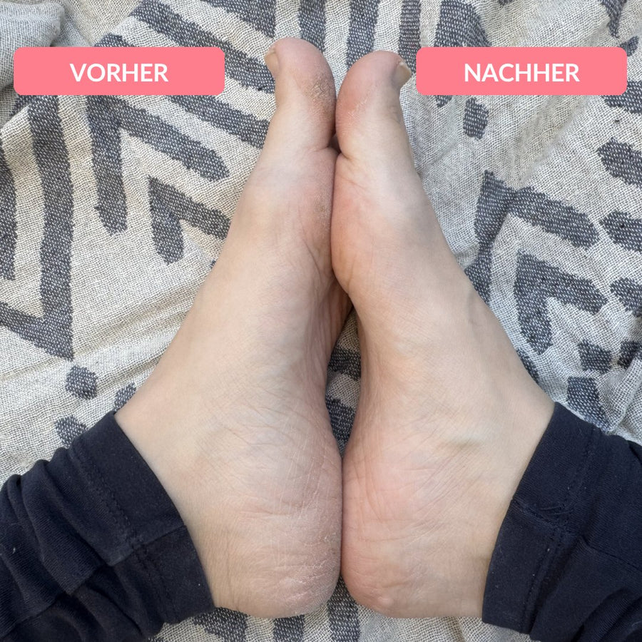 Trockene Füße vorher und nachher